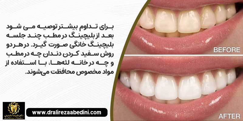 انواع روش های بلیچینگ دندان در نجف آباد توسط دکتر علیرضا عابدینی