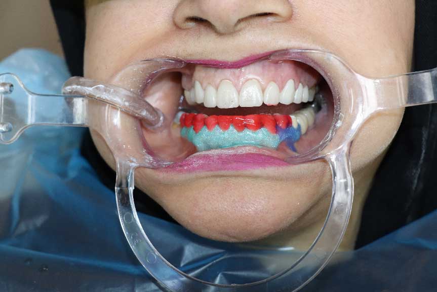 تشریح یکی از موارد مشکل و شایع دندانپزشکی زیبایی