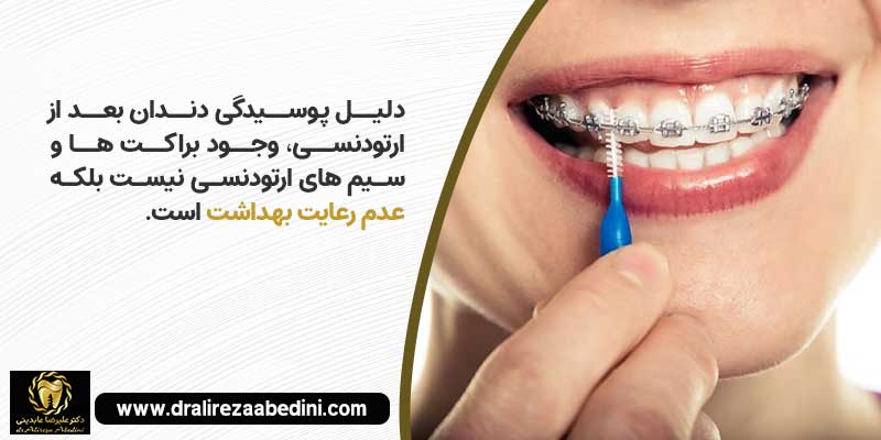 عوارض اصلاح طرح لبخند با ارتودنسی دندان