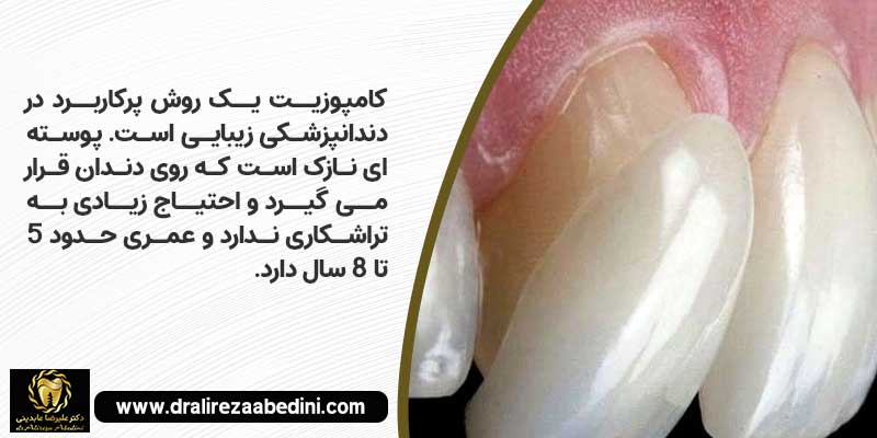 کامپوزیت توسط دکتر علیرضا عابدینی بهترین متخصص دندانپزشکی ترمیمی زیبایی نجف آباد