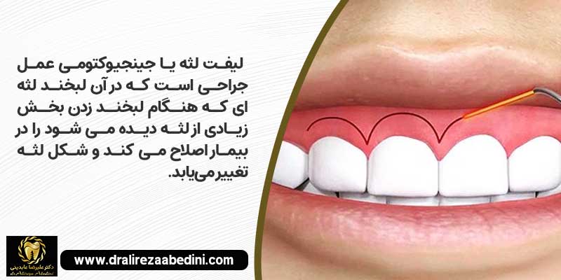 لیفت لثه با لیزر در بهترین دندانپزشکی ترمیمی نجف آباد توسط دکتر علیرضا عابدینی